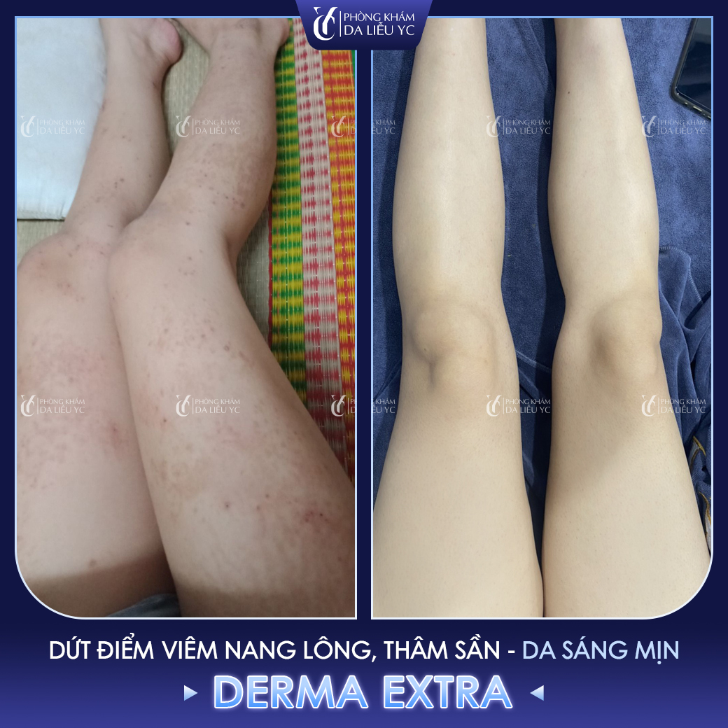 Điều trị viêm nang lông chân bằng công nghệ Derma Extra được nhiều người lựa chọn