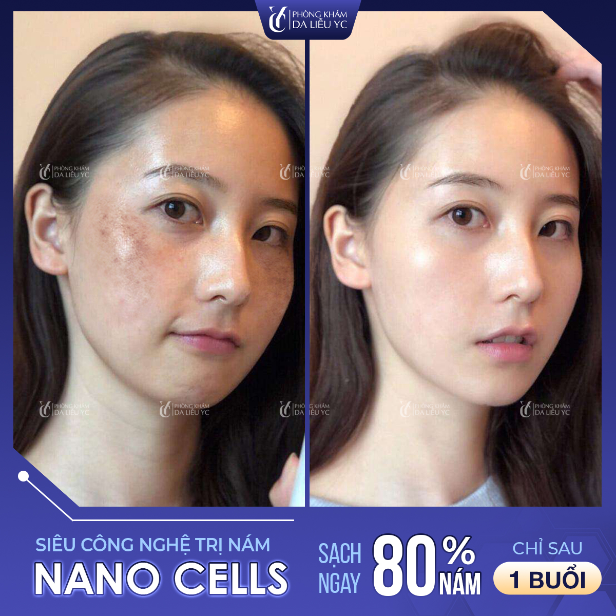Công nghệ Nano Cell đã giúp hàng ngàn phụ nữ Việt xóa bỏ các mảng nám triệt để