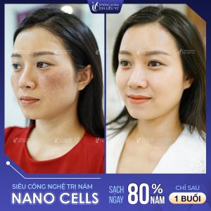 Nano Cell là giải pháp trị nám thế hệ mới được FDA của Hoa Kỳ chứng nhận
