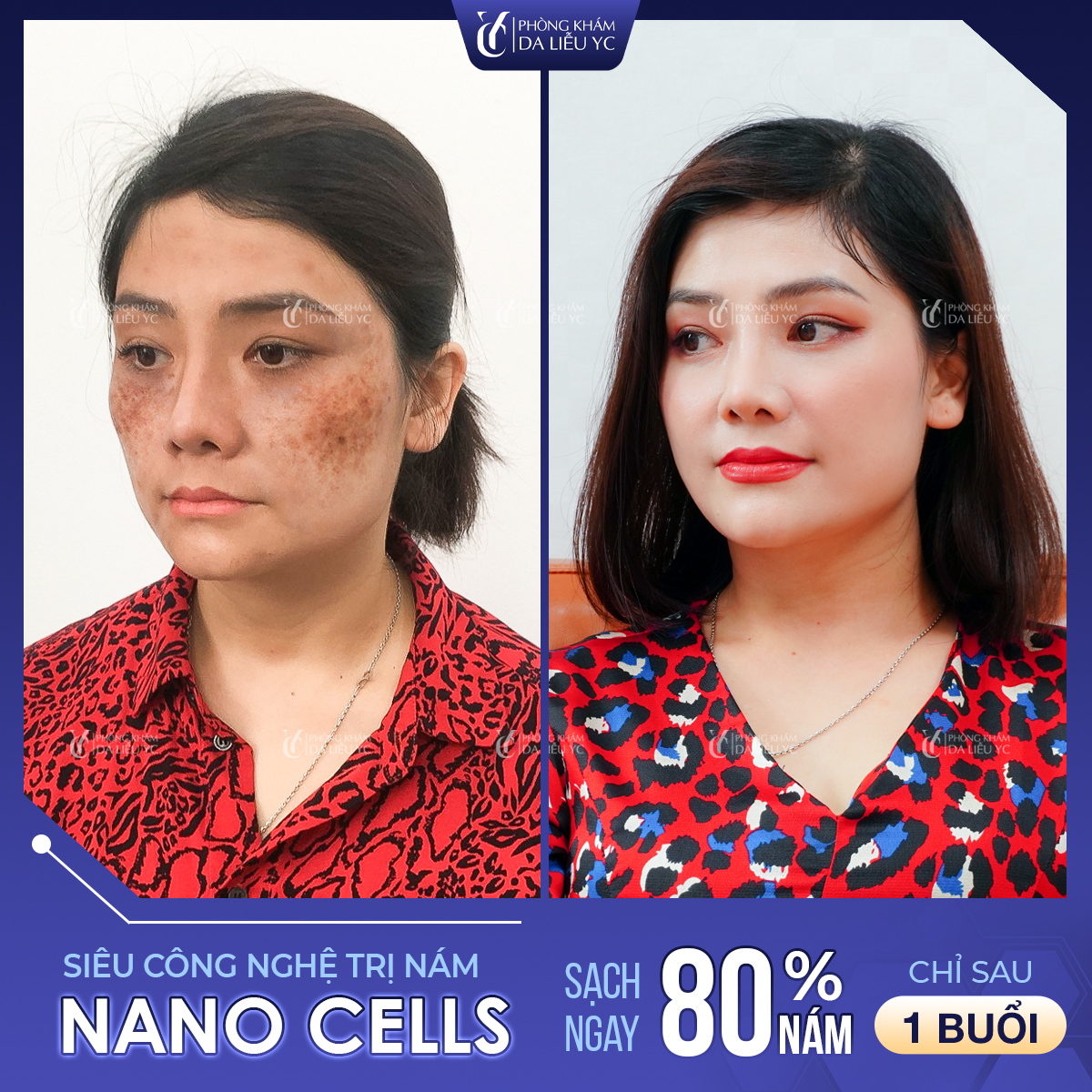 Công nghệ Nano Cell xóa bỏ mọi vết nám chỉ ngay lần thực hiện đầu tiên