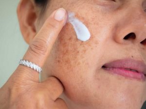 Sử dụng kem trị nám, peel da, bắn tia laser có nguy cơ làm tổn thương da