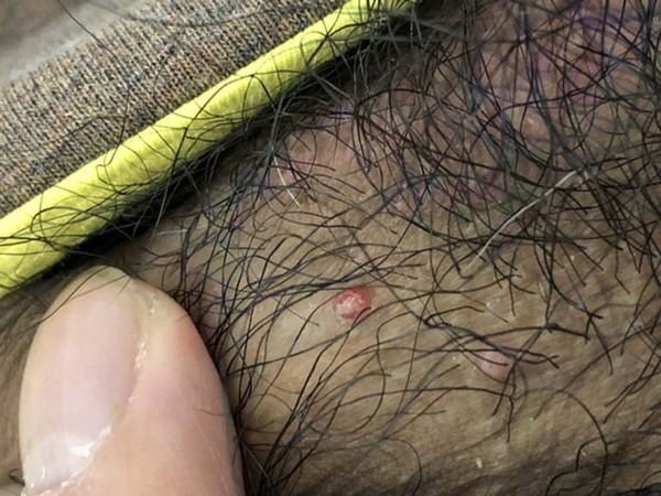 hình ảnh viêm nang lông ở chân